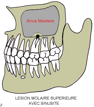Sinusites d'origine dentaire. — Conseil Dentaire Dr.Hauteville