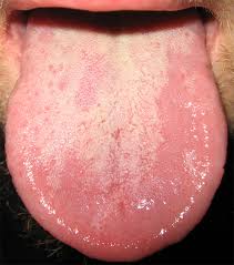 comment soigner mycose bouche